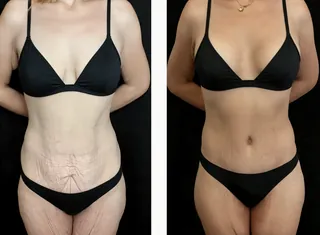 Antes e depois — Contorno Pós-Bariátrica