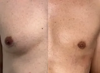 Antes e depois — Ginecomastia