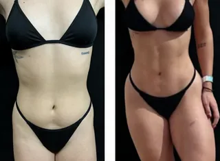 Antes e depois — Lipo HD