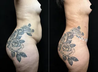 Antes e depois — Lipoabdominoplastia HD