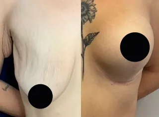 Antes e depois — Mastopexia com prótese
