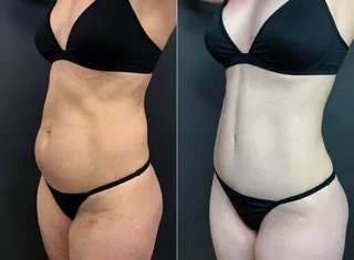 Antes e depois — Mommy Makeover